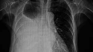 Detección de Derrame Pleural