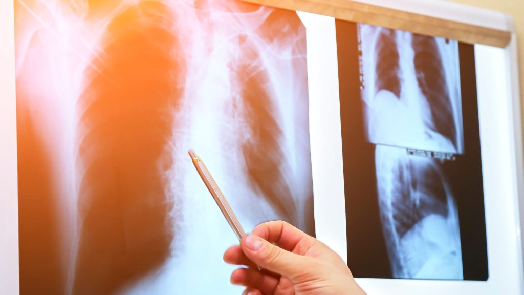 Detección de Derrame Pleural 1 Qué es el Derrame Pleural y sus Causas Principales